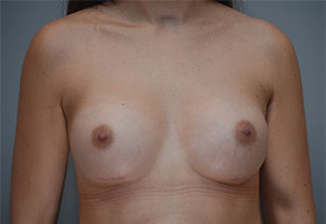 Breast Augmentation Before & After Patient #358
