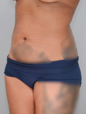 Liposuction Before & After Patient #1641