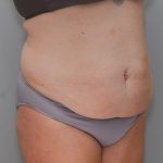 Abdominoplasty Before & After Patient #1211