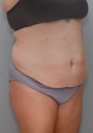 Abdominoplasty Before & After Patient #1211