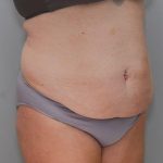 Abdominoplasty Before & After Patient #1590