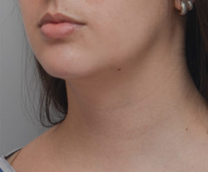 Neck Liposuction Before & After Patient #1948