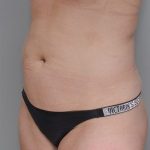 Liposuction with Bodytite Before & After Patient #1557