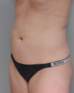 Liposuction Before & After Patient #1646