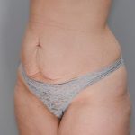 Abdominoplasty Before & After Patient #1270