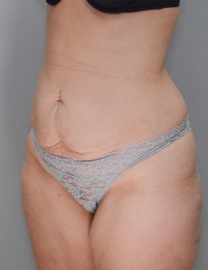 Liposuction Before & After Patient #1642