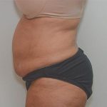 Abdominoplasty Before & After Patient #1207