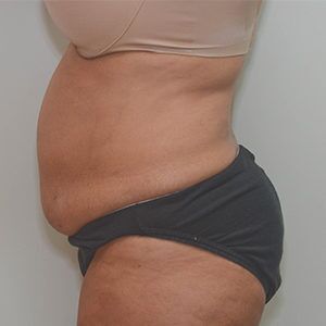 Liposuction Before & After Patient #1586