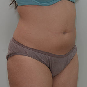 Abdominoplasty Before & After Patient #1208