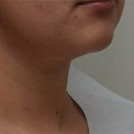 Neck Liposuction Before & After Patient #2004