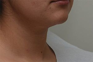 Neck Liposuction Before & After Patient #2004