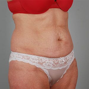 Abdominoplasty Before & After Patient #1209