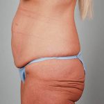 Abdominoplasty Before & After Patient #1327