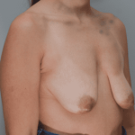 Breast Lift Before & After Patient #898