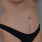 Abdominoplasty Before & After Patient #1493