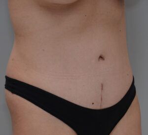 Abdominoplasty Before & After Patient #1493