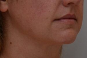 Neck Liposuction Before & After Patient #2008