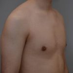 Gynecomastia Before & After Patient #1160