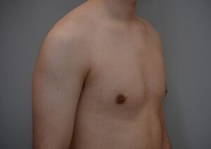 Gynecomastia Before & After Patient #1160