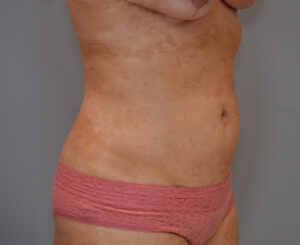 Liposuction with Bodytite Before & After Patient #1558