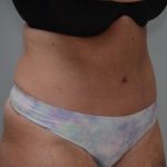 Abdominoplasty Before & After Patient #1496