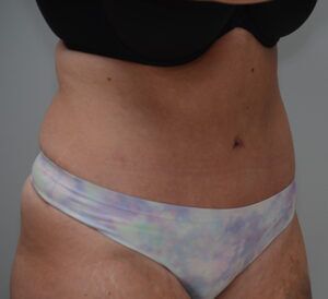 Abdominoplasty Before & After Patient #1496