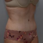 Abdominoplasty Before & After Patient #1495