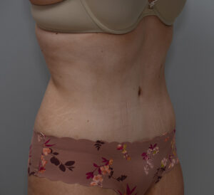 Abdominoplasty Before & After Patient #1495