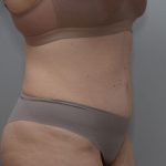 Abdominoplasty Before & After Patient #1494