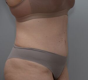 Abdominoplasty Before & After Patient #1494