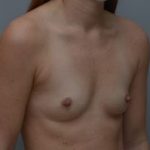 Breast Augmentation Before & After Patient #413