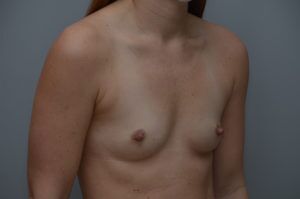 Breast Augmentation Before & After Patient #413