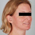 Facelift Before & After Patient #1743