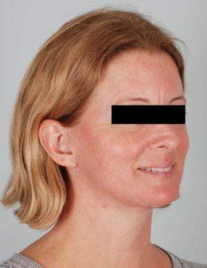 Face And Neck Lift Before & After Patient #1743