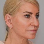 Facelift Before & After Patient #1745