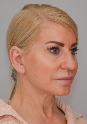 Facelift Before & After Patient #1745