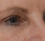 Blepharoplasty Before & After Patient #1704