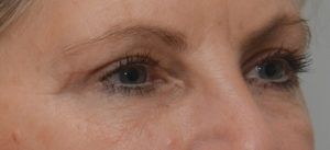 Blepharoplasty Before & After Patient #1704