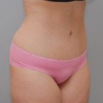 Abdominoplasty Before & After Patient #1271