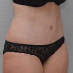 Abdominoplasty Before & After Patient #1387