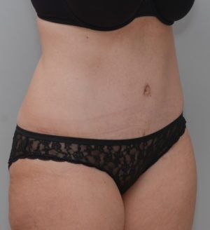 Abdominoplasty Before & After Patient #1387