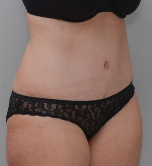 Abdominoplasty Before & After Patient #1644