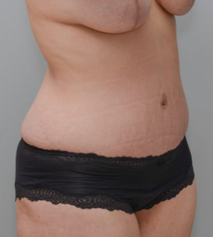 Abdominoplasty Before & After Patient #1440