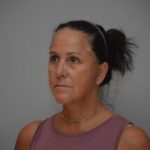 Facelift Before & After Patient #1744