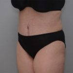 Abdominoplasty Before & After Patient #1210