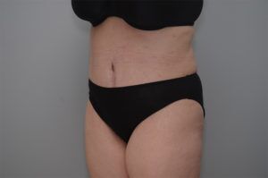 Abdominoplasty Before & After Patient #1210