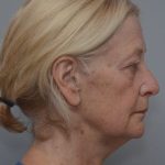 Facetite Before & After Patient #1777