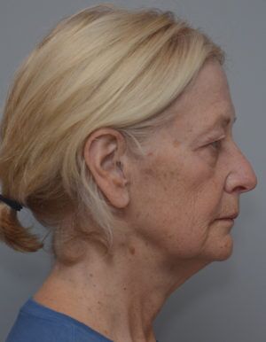 Facetite Before & After Patient #1777