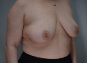 Breast Reduction Before & After Patient #1131