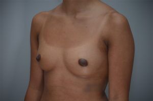 Breast Augmentation Before & After Patient #248